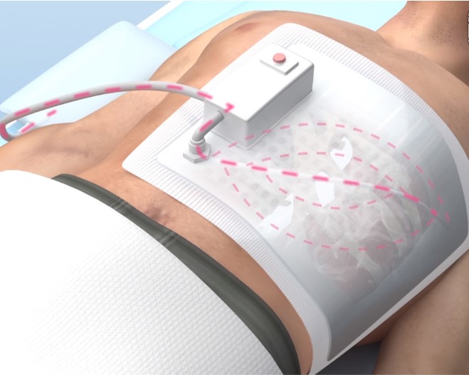 胸部负压支撑器：胸部严重损伤的救治利器